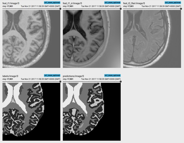 medical image classification with TenosrFlow
